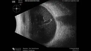 .20 MHz Annular Ophthalmic Ultrasound ABSolu, Large amount of subhyaloid hemorrhage , 36910