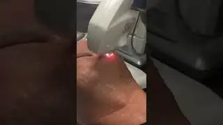 Watch Your Sunspots Vanish with IPL! #ipl #viral