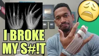 I BROKE MY FINGER