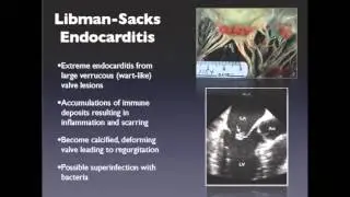 Lupus and Heart Disease. Dr Vikram Raya