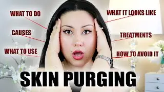 SKIN PURGING (Fully Explained) | Is It a Good Sign? Causes Of Skin Purging & What To Use | Zulayla