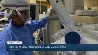 Robotic technology used to diagnose early stage lung cancer