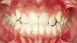 Tratamento ortod&ocirc;ntico   Ortodontia corretiva   T&eacute;cnica Straight Wire