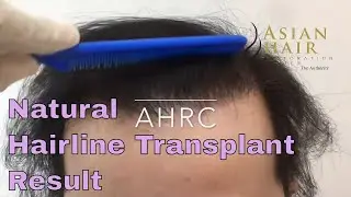 Natural Hairline Transplant Result  | Asian Hair Restoration Center