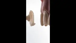 Dental veneers are irreversible