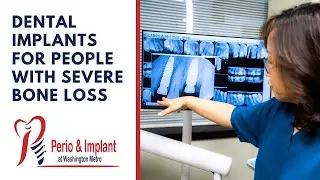 Dental Implants For People With Severe Bone Loss