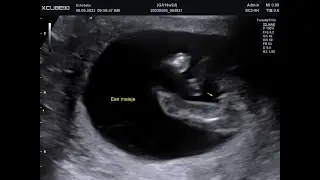 2D Echo 14 Weken Zwanger Geslachtsbepaling Meisjes, Foto's en Filmpjes