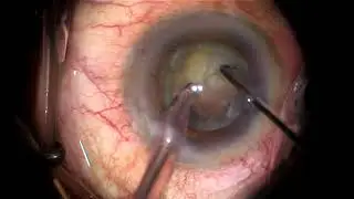Direct chopping by Dr Amro Mahfouz