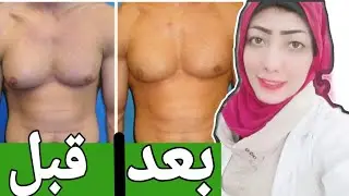 أسباب وطرق علاج التثدى عند الرجال- gynecomastia - العياده
