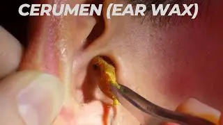 CERUMEN / EAR WAX - ent series