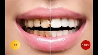 Snap On Smile Отзывы
