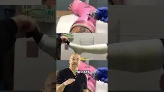 Achilles Rupture Cast: How Long? #shorts