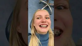 Hebben jullie beugel tips?? 😬
