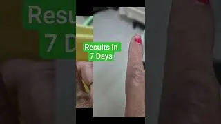 Finger Psoriasis 7 Din Mein Control | Homeopathic Treatment | Real Improvement #shorts #shortsfeed
