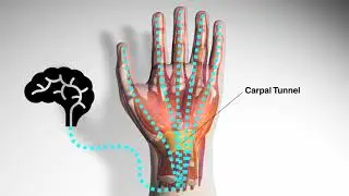 What is Carpal Tunnel Syndrome? | HAVS | iHASCO