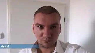 Mike neemt je mee tijdens zijn herstel van zijn haartransplantatie!