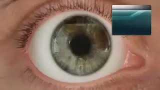 Alcon WaveLight Refractive Suite Overview