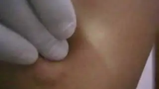How To Elicit Slip Sign To Differentiate Cyst & Lipoma?