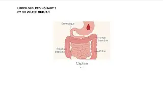 Gi bleeding  part 2 #viral #medicine #health #education #faltudoctor#drvikash