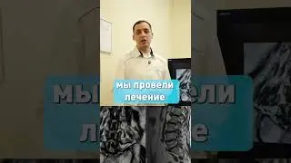 Patient story | Spondyloarthrosis | RFD method #shorts #rfd