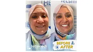 Hollywood Smile Procedure 🦷 Before & After