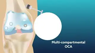 Using osteochondral allograft transplantation to treat articular cartilage lesions of the knee