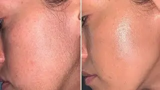 Unnecessary facial hair remove by face wax method with easy tecnique