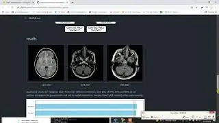 Batch Normalization for Biomedical Image Segmentation || abnormality segmentation in brain MRI