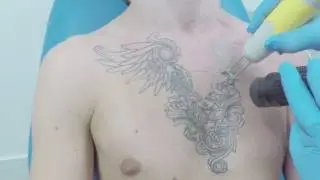 Tattoo verwijderen bij Het Lasercentrum