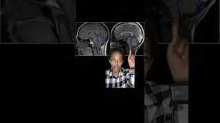 Chiari malformation 1 in Amharic