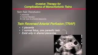 UCSF Radiology: Operating on Twins in the Womb