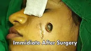 Best Clinics for Birthmark Removal With Excision Surgery By Expert Plastic Surgeon, Rajkot, Surat