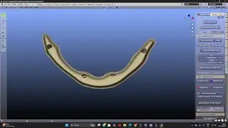Ibar designing for lower full arch in mu implants - best laser dental clinic chennai