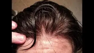 Strong and invisible hair replacement system from 45 dol what sapp 008613375586492
