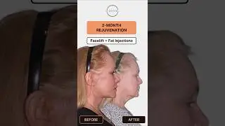 66-Year-Old&rsquo;s 2-Month Facelift Results | Lip Lift, Lower Bleph & Fat Injections