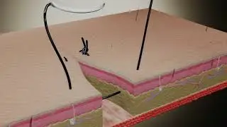 Suture Techniques - Horizontal Mattress U-Shaped Suture