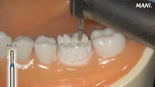 MANI DIA-BURS KIT  Posterior crown preparation
