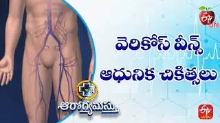 Varicose Veins: Latest Treatments | వెరికోస్ వీన్స్ –ఆధునిక చికిత్సలు | Aarogyamastu | 21st Jan 2023