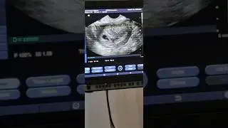 Echo bij 6 weken zwanger