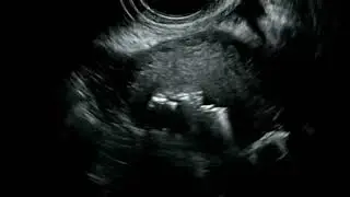 FemVue Challenging Case Example 2 &ndash; Difficult to Visualize Left Tube