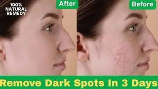 How to remove face Pimples, Acne Spots & Dark Spots? Naturally Home Remedy That Actually Works 💕 |