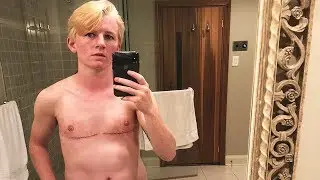 1 Month Post Top Surgery (FTM) | Harrison Browne