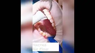 Air Flow &mdash; этап профгигиены полости рта  Удаляем биопленку