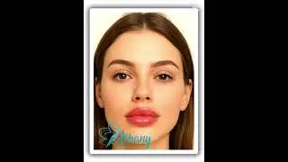 Volume with precision. This #lipfiller transformation enhances natural beauty with soft, plump r