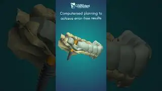 Computer-Guided Dental Implants | Precision Implant Placement at Richas Cosmodental
