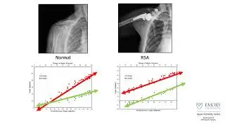 Shoulder Arthroplasty | Orthopedic Applications for DDR | Konica Minolta