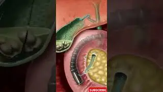 How They Remove Gallstones (ERCP Procedure)