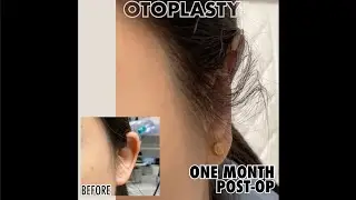 Female Otoplasty - The Hottest New Trend