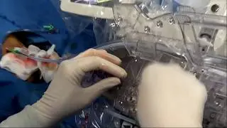 Robotic PCI of LAD Lesion