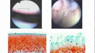 Arthritis: Spotlight on Stem Cell Research - Bill Robinson